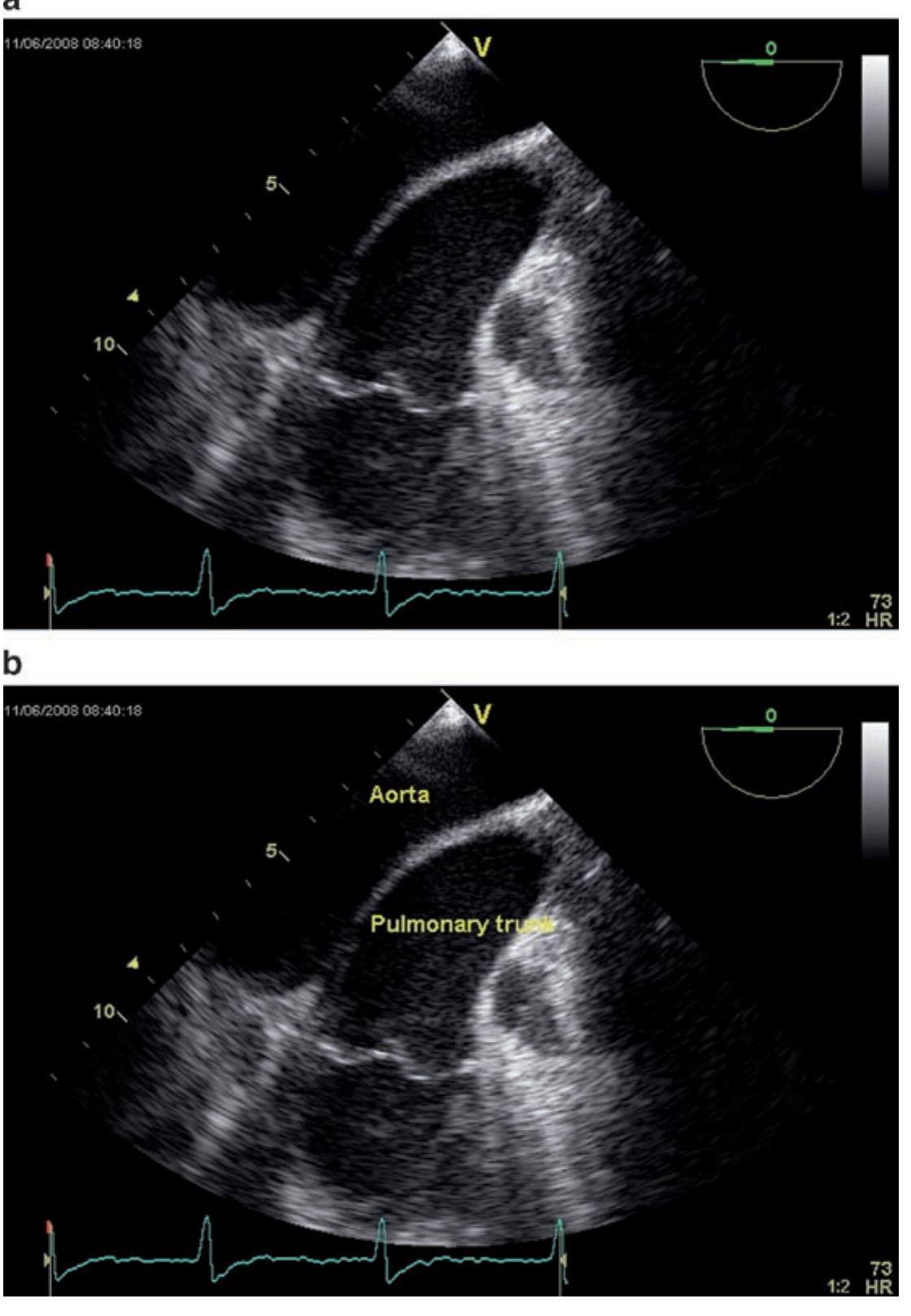 PDF) Transesophageal Echocardiography in Clinical Practice