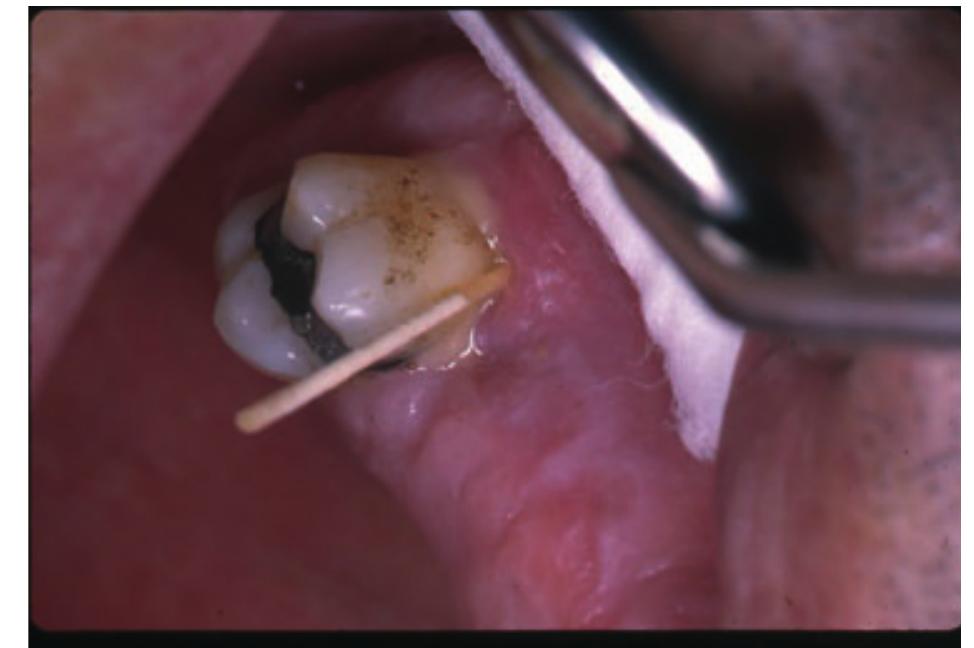 (PDF) Acute periodontal lesions