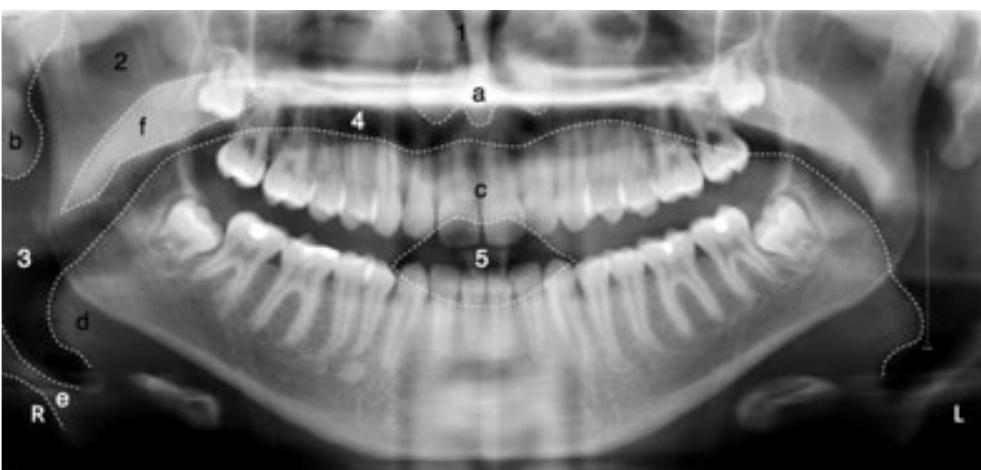 Perfect Pan Radiograph (PDF) Interpretation of panoramic radiographs