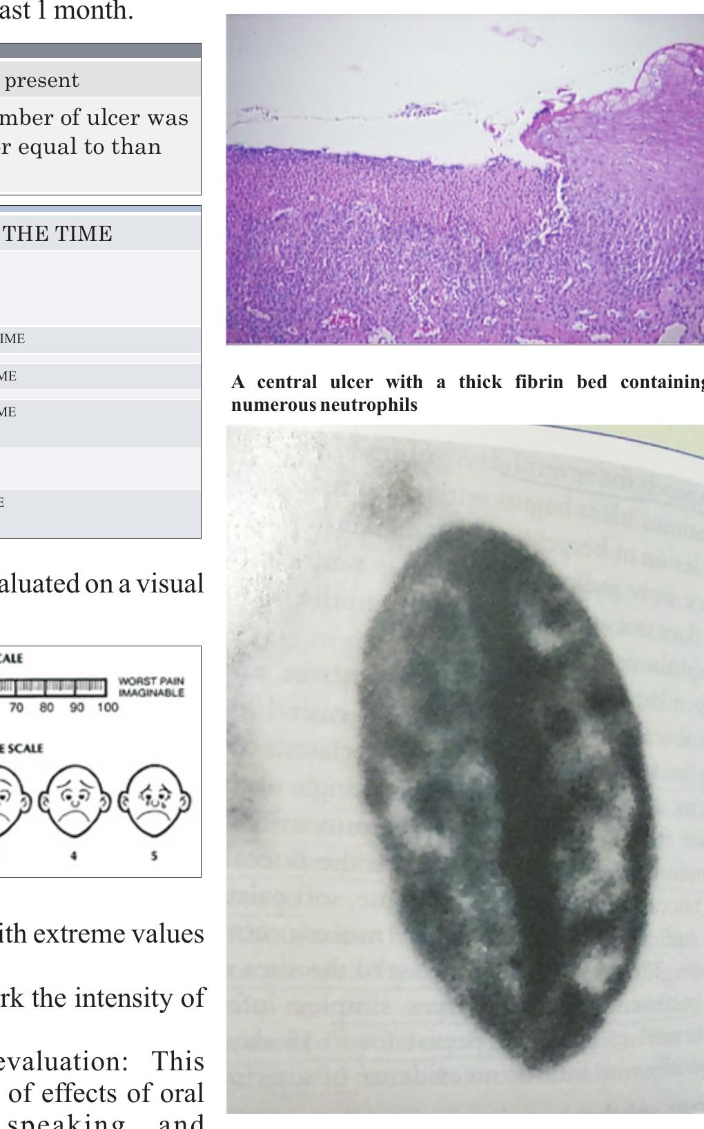 Major Ras (PDF) Recurrent Apthous stomatitis :A case report