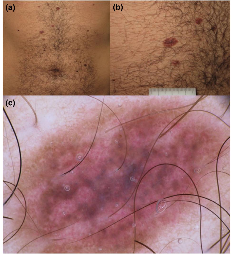 (PDF) Melanocytic nevi with special features: clinical- dermoscopic and ...