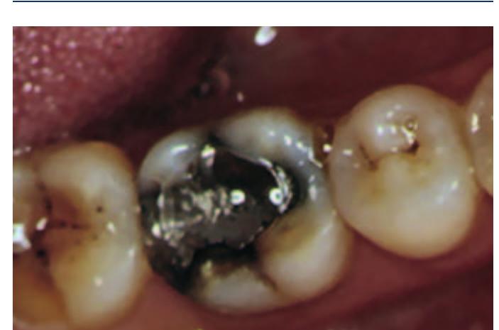 The presence of marginal fractures and staining are