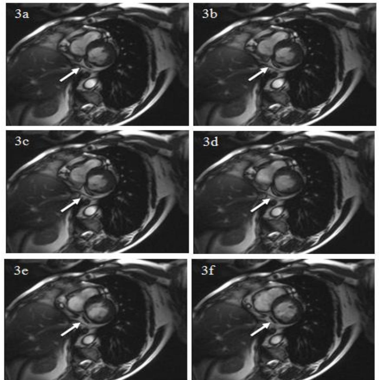 (PDF) Comparative Assessment of Wall Motion Score Index and Left ...