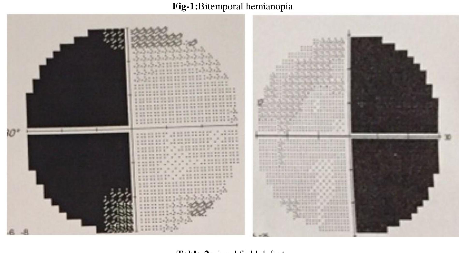 (PDF) A prospective observational study on neurological visual field ...
