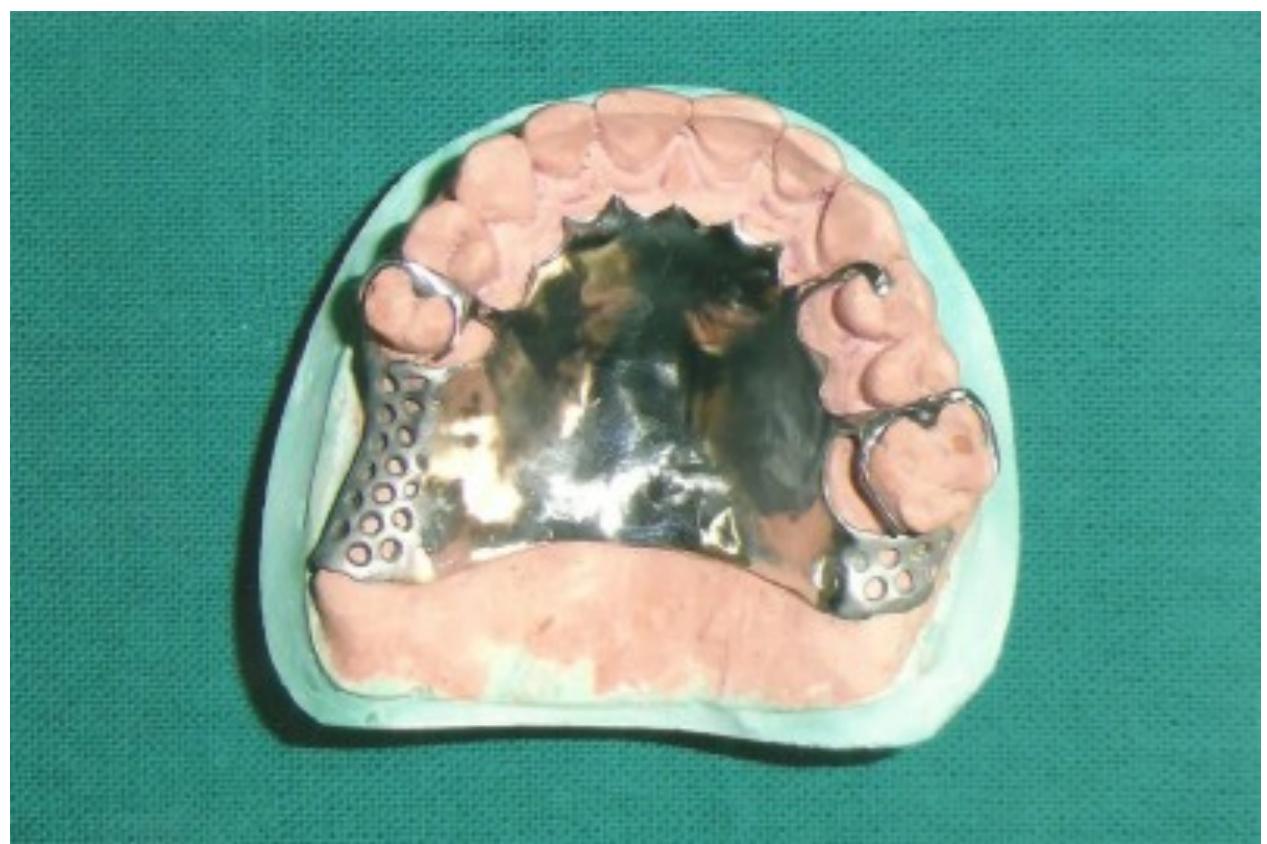 Figure 1 - from Simplifying designing of a cast partial