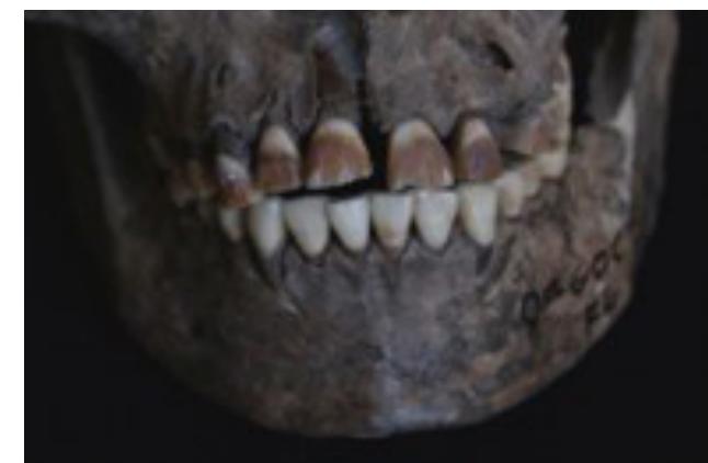 Figure 4. Individual with labial and buccal staining on the upper and lower jaw. Photo: S. Krais.  Figure 5. Labial and buccal staining on the upper jaw. Photo: S. Krais. 