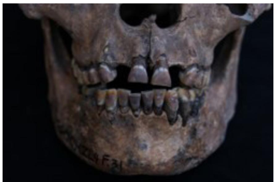 Figure 10. Dental ablation additional to labial and buccal staining on the upper and lower jaw. Photo: S. Krais.  Ablation 