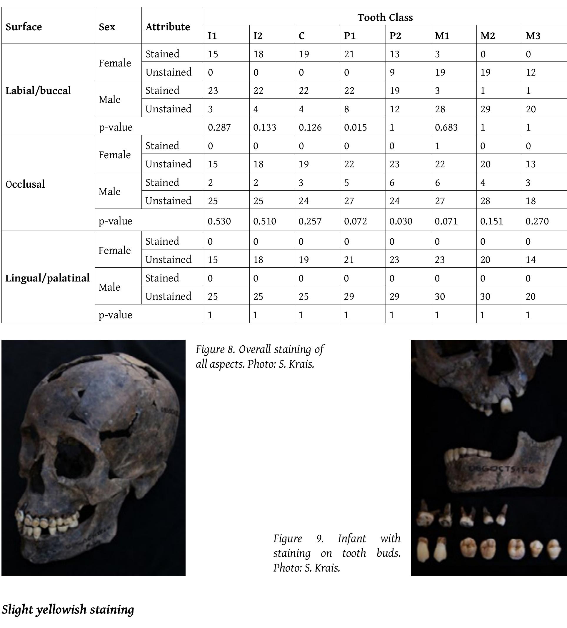 Five individuals from Go 6 Chua (20.8%) and one individual from Prohear show very light brownish to yellowish staining (Figure 8; Table 2). Within this group there seems to be little accordance between the patterns besides the low intensity itself. Three individuals show the staining on all aspects of the teeth almost evenly, while three show the staining only on the labial/buccal aspects. Surprisingly, one individual from Gd 6 Chia (06GOC TS1 F6) additionally has seven stained unerupted teeth (Figure 9).  Table 3. Staining pattern of Go 6 Chua subsample, distributed by tooth class for female and male individuals, based or individuals of group 2 ‘tooth blackening - upper and lower jaw’ and group 3 ‘tooth blackening - only upper jaw’ from Table z (n=386). 