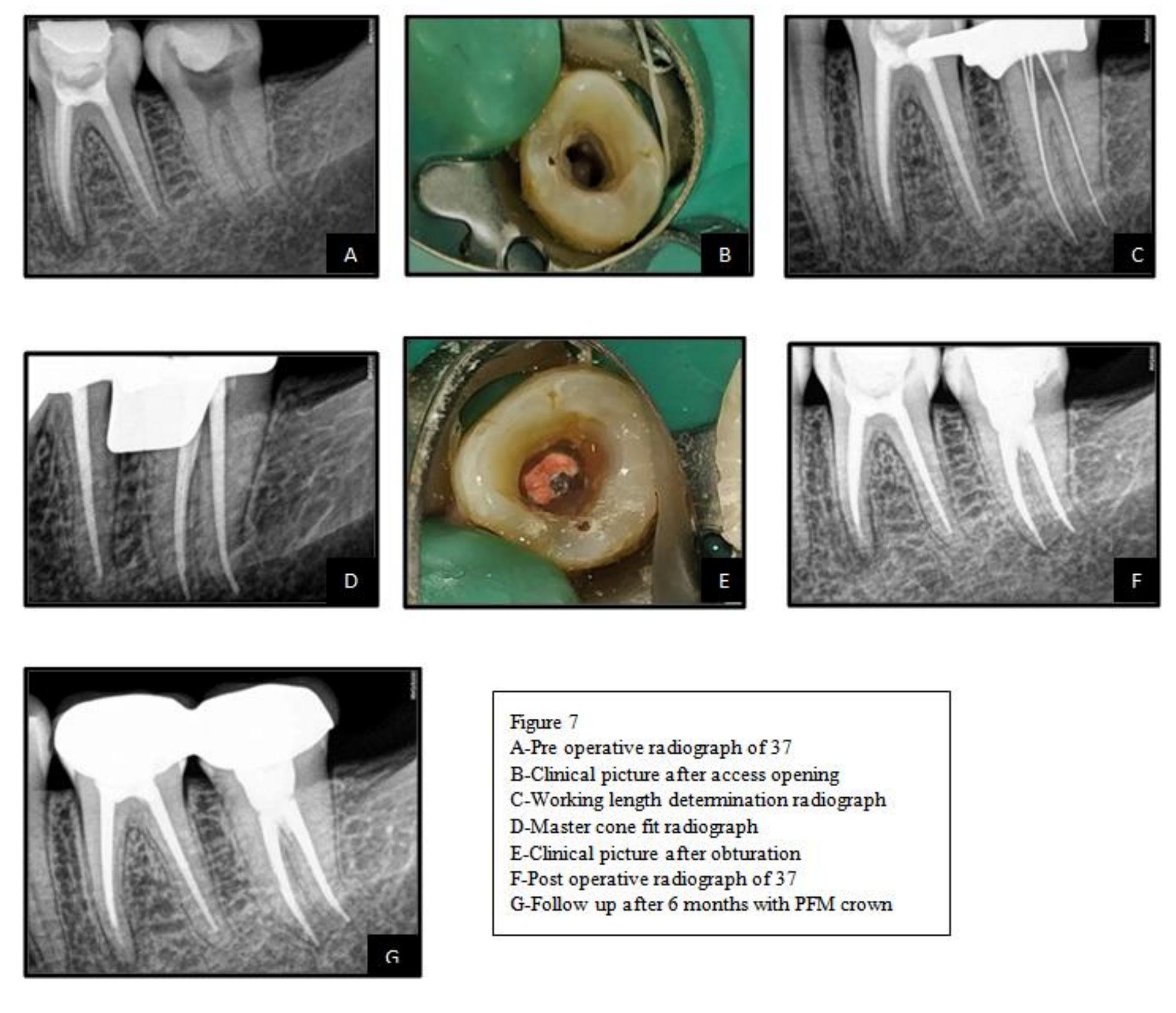 (PDF) Different Obturating Techniques For Endodontic Management Of C ...