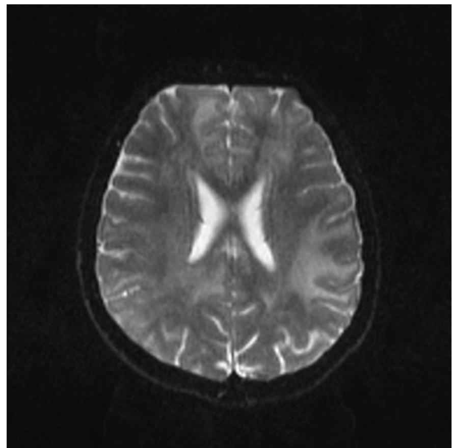 Neurosyphilis. mri (t2-w flair) coronal section: bilateral