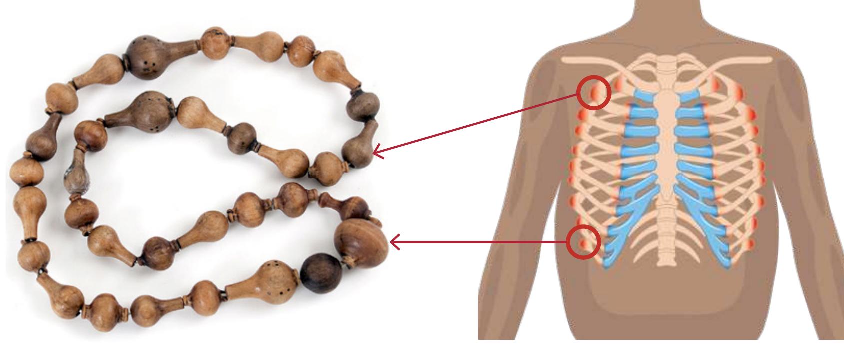 Figure 5 - from Nutritional rickets: a review of disease