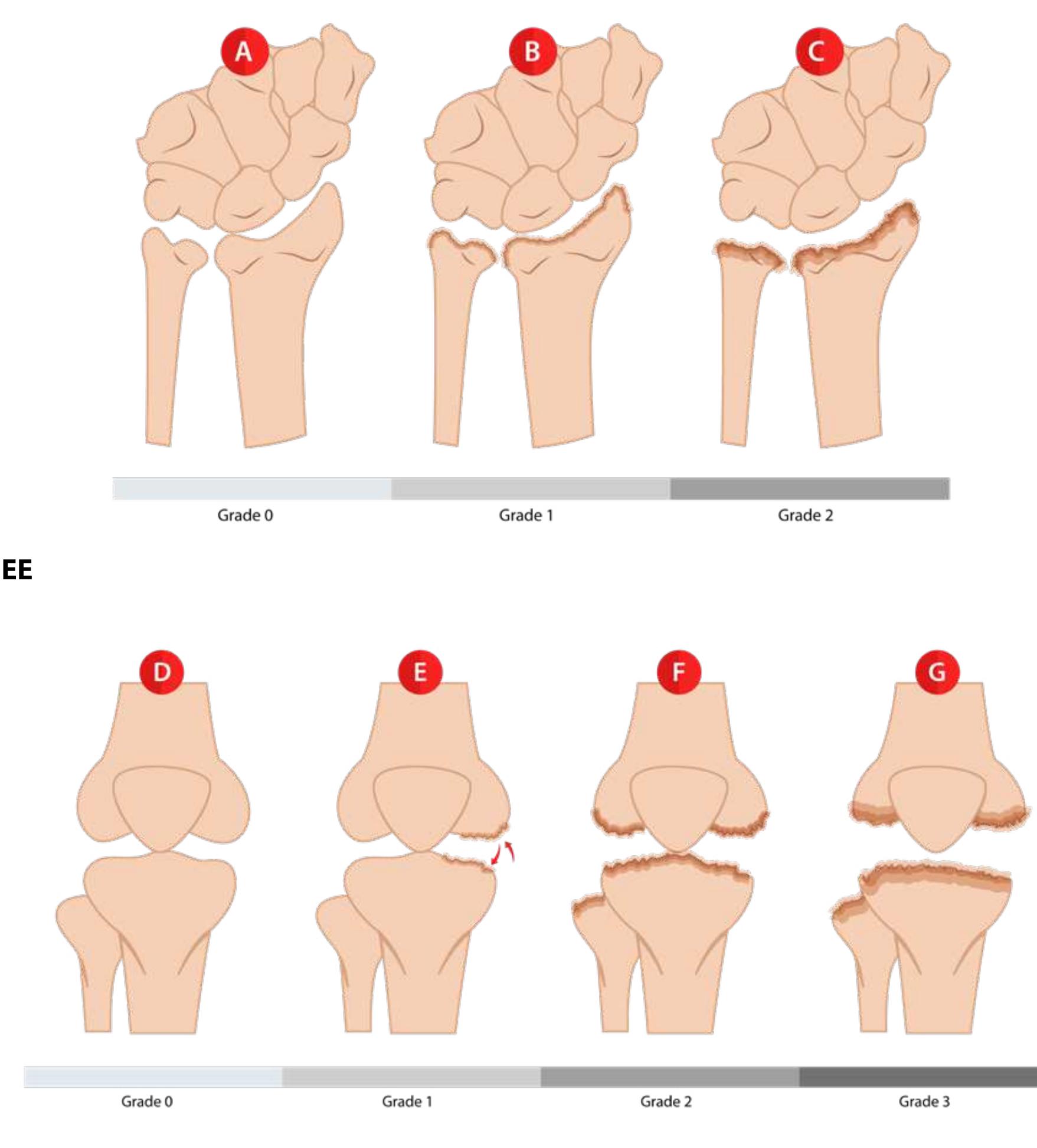 (PDF) Nutritional rickets: a review of disease burden, causes ...