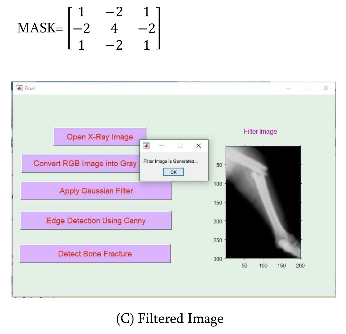 (PDF) Identification of Bone Fracture using Image Processing
