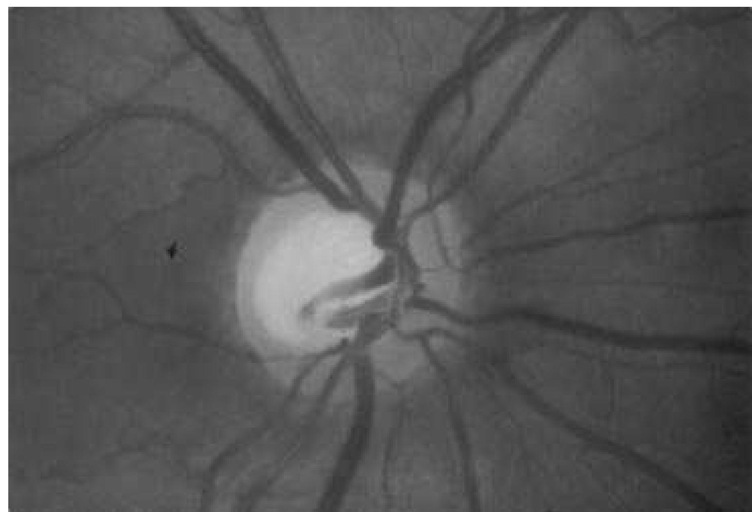 Region Disc Photograph of a normal right optic disc showing the