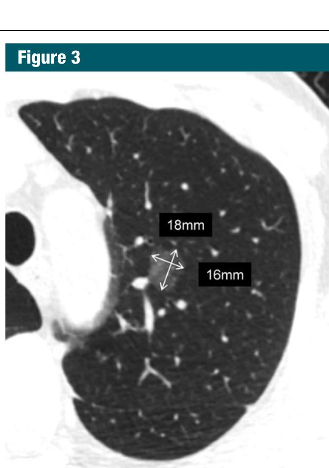 Transverse ct section of a pure ground- glass nodule in the