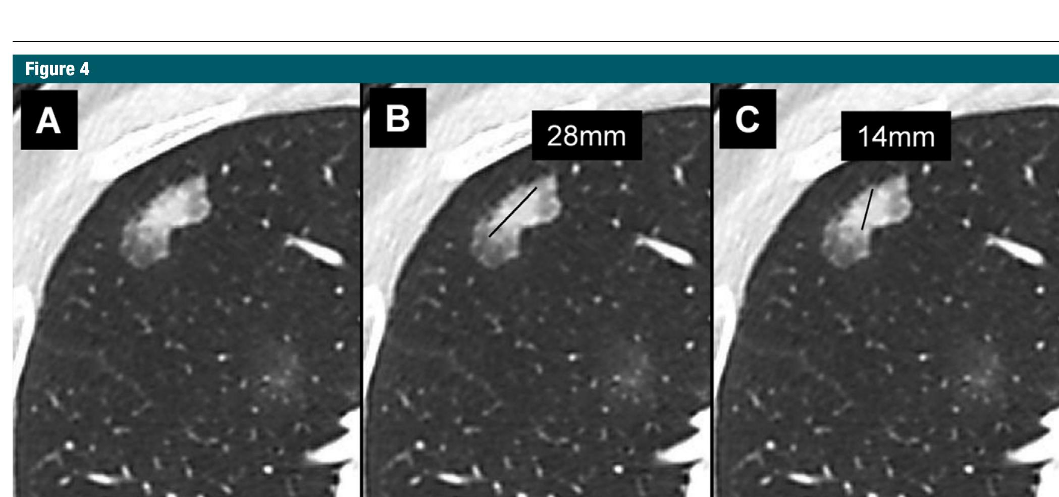 Part Solid Nodule
