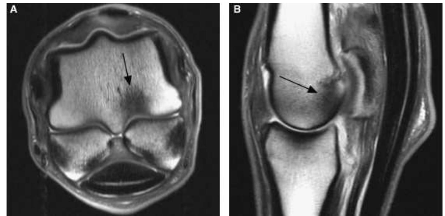Figure 2 - from Follow-Up Magnetic Resonance Imaging of