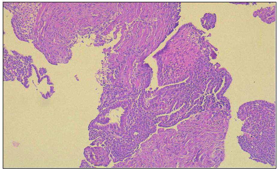 (PDF) Endometriosis in an episiotomy scar: a case report