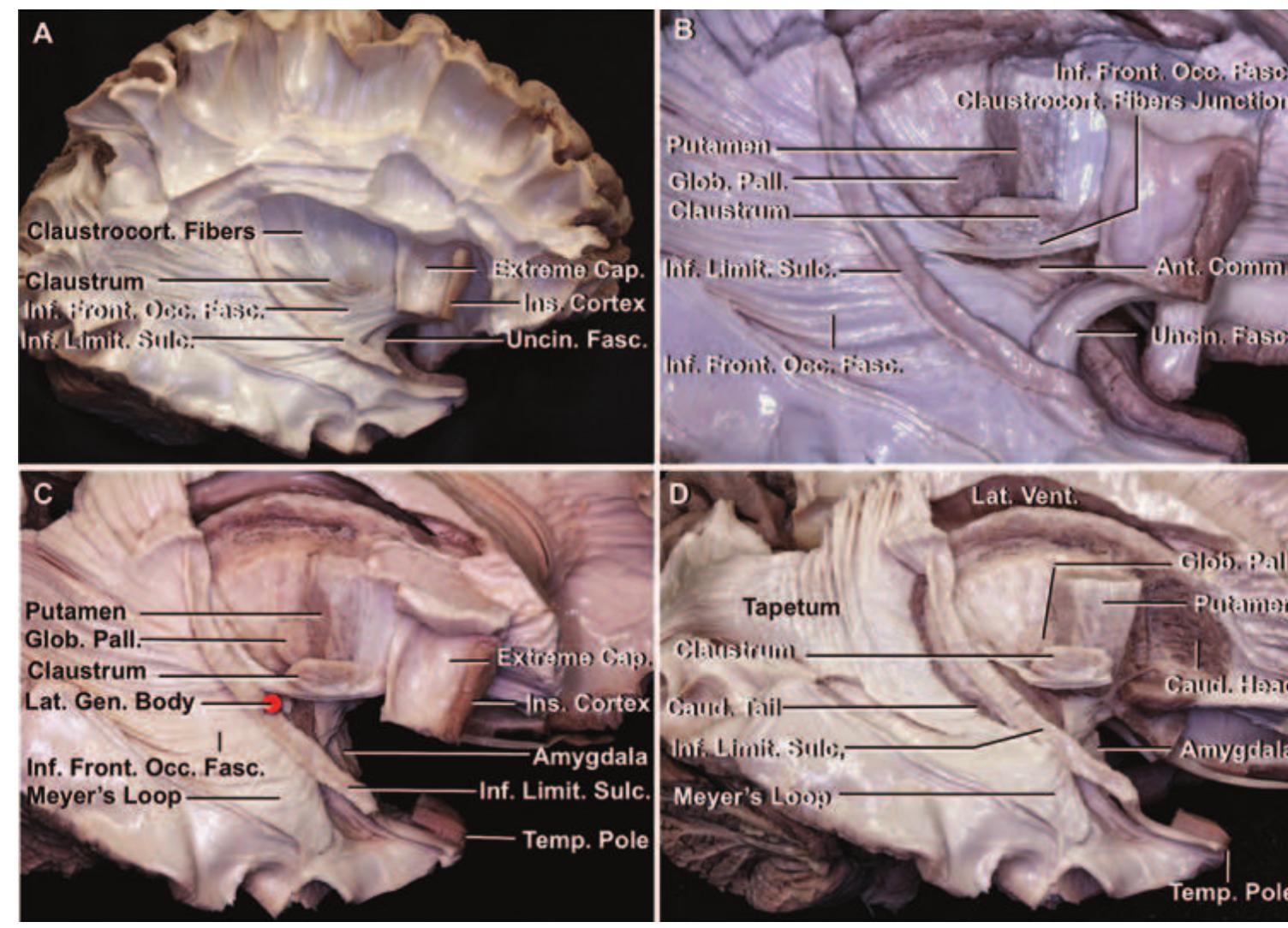 Stepwise insular dissection. a: the opercula were removed to