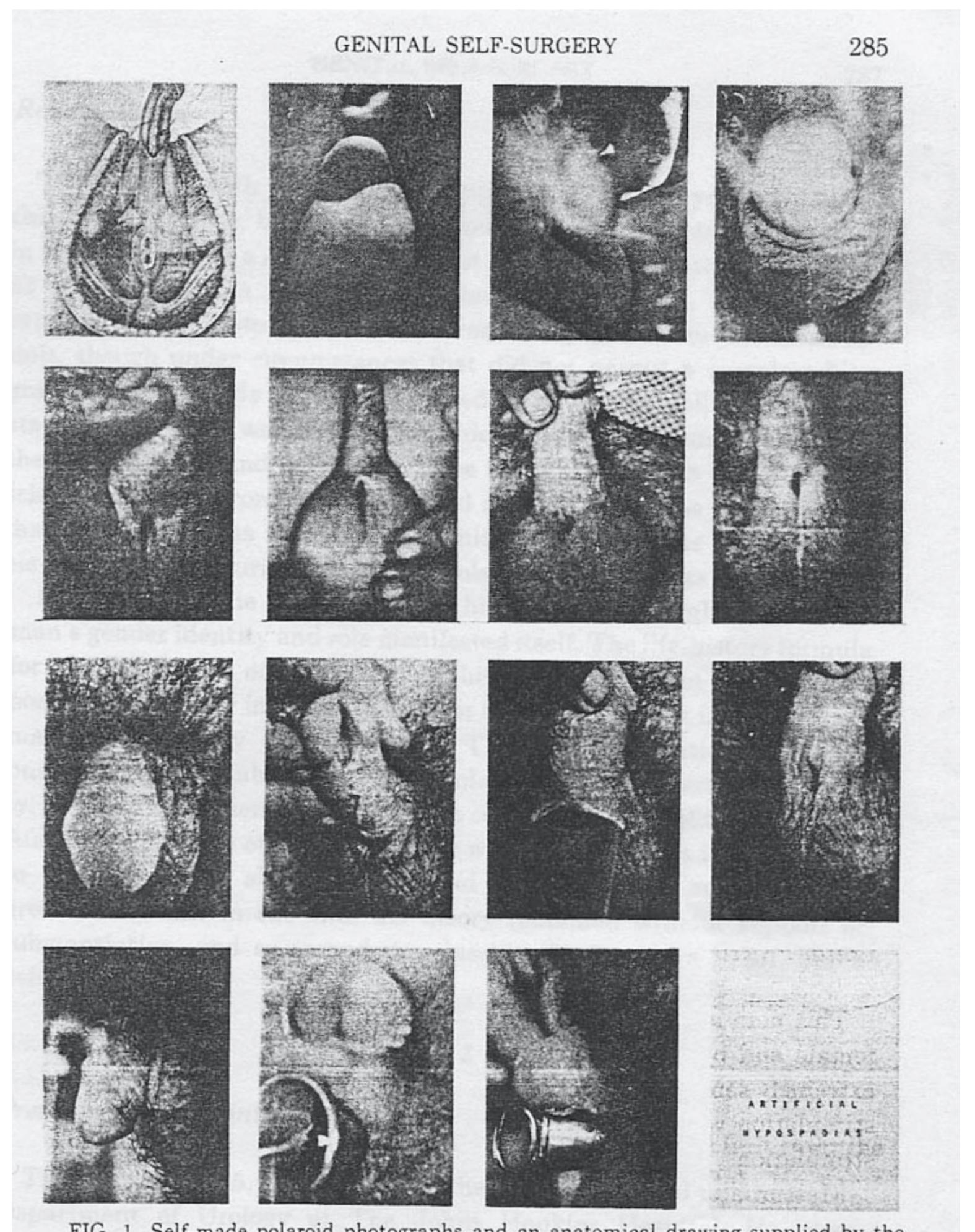 enough to insert a tapered candle (which he used to masturbate). The whole operation, Bess’s  2 Forrest Bess, exh. cat., with an essay by Meyer Schapiro (New York: Betty Parsons, 1962); Forrest Bess, edited by Barbara Haskell, exh. cat. (New York: Whitney Museum of American Art, 1981); John Money and Michael De Priest, “Three Cases of Genital Self-Surgery and their Relationship to Transexualism,” Journal of Sex Research 12 no. 4 (1976): 283-94, especially “case 1,” 284-87. Aside from Bess’s theories about alchemical immortality, the immediate object of the incision was “to allow a ‘host penis’ to gain access to the bulbous urethra [bulbous urethre|,” a swelling posterior to the penis, in order to effect a “urethral orgasm.” Ibid., 284. 