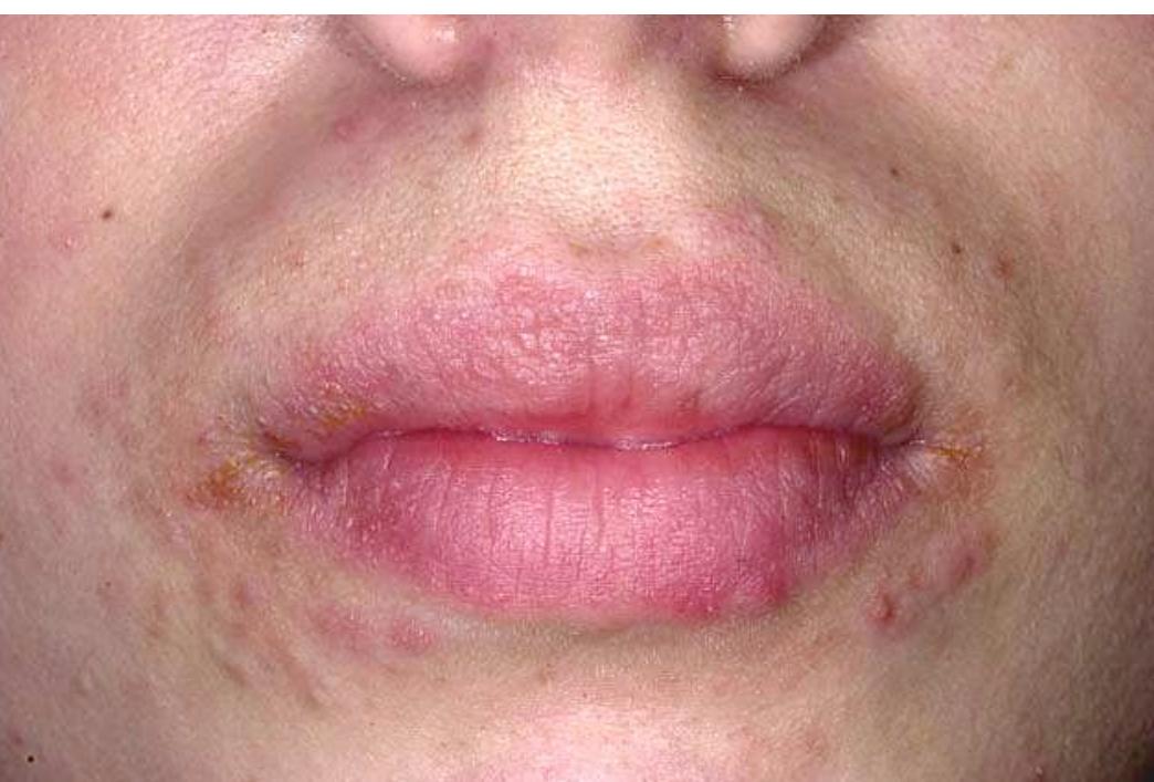 “thickened scaly skin” of psoriasis occurs on patients who have feelings of vulnerabiliy, 
