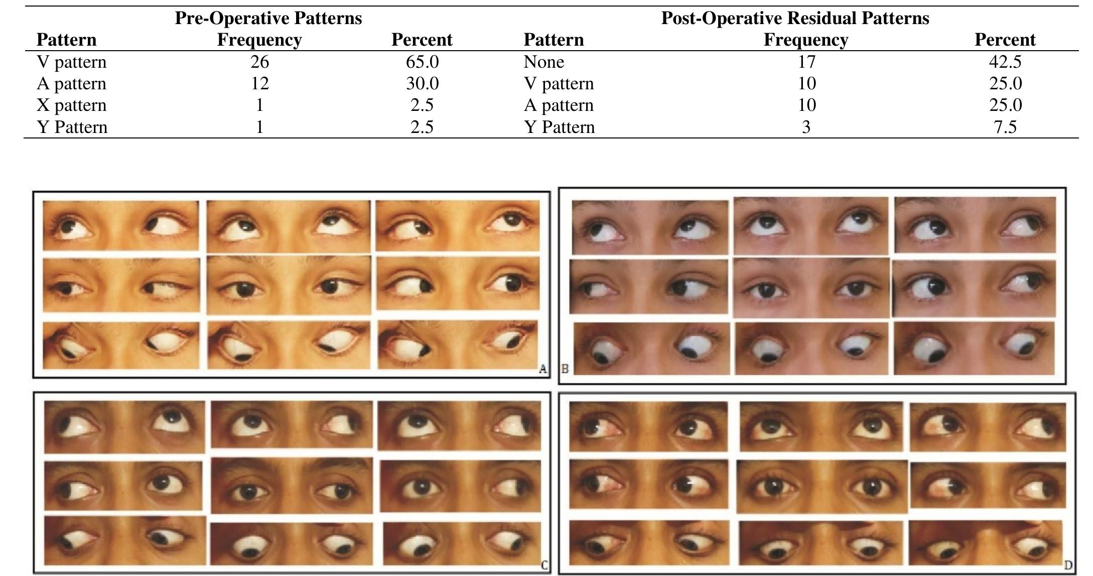 (PDF) Types of Pattern Strabismus and Their Surgical Outcomes after ...