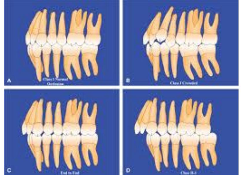 (PDF) The Curve of Dental Arch in Normal Occlusion