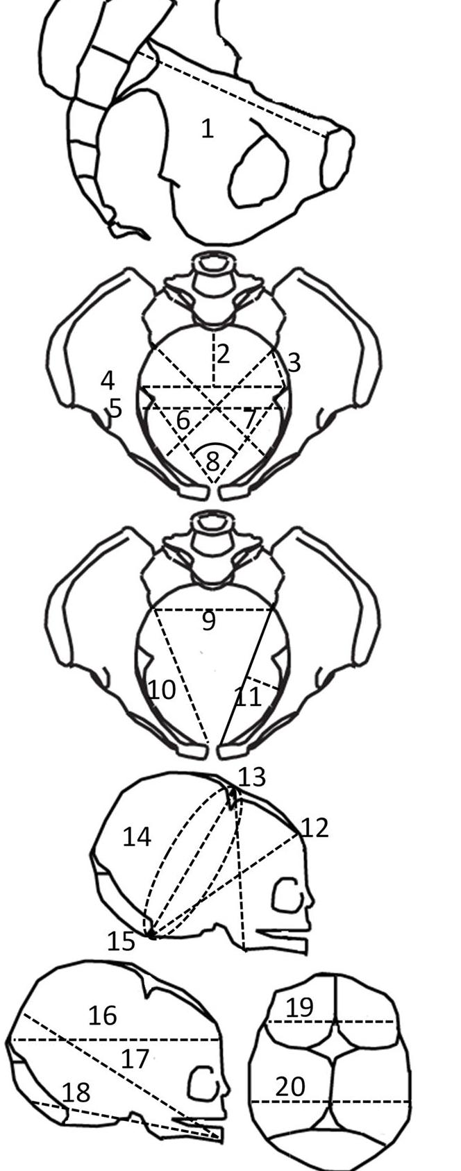 Fig. 2 Foetal-pelvic variables: 1: Inlet antero-posterior, 2: Sagittal posterior inlet, 3: Left inlet posterior space, 4: Maximal transverse inlet, 5: Medial transverse inlet, 6: Left oblique inlet, 7: Right oblique inlet, 8: Pectineal angle, 9: Sacral breadth, 10: Right ilio-pectineal chord length, 11: Left iliopectineal chord subtense, 12: suboccipito- frontal, 13:submentobregmatic, 14:suboccipitobregmatic circumfer- ence, 15: suboccipitobregmatic, 16: occipitofrontal, 17: mentovertical, 18: mentooccipital, 19: bitemporal, 20: biparietal / Variables foeto- pelviennes : 1: antéro-postérieur du deétroit supérieur, 2 : Sagittal pos- térieur du détroit supérieur, 3 : Espace postérieur gauche du detroit supérieur, 4: Transverse maximum, 5 : Transverse médian du détroit supérieur, 6 : Oblique gauche du deétroit supérieur, 7 : Oblique droit du detroit supérieur, 8 : Angle de larc antérieur, 9 : Largeur sacrée, 10 : Corde ilio-pectinée droite, 11 : Fléche ilio-pectinée gauche, 12 : Sous-occipito-frontal, 13 : Sous-mento-bregmatique, 14 : Circon- ference sous-occipito-bregmatique, 15 : Sous-occipito-bregmatique, 16 : Occipito-frontal, 17 : Sincipito-mentonnier, 18 : Occipito- mentonnier, 19 : Bitemporal, 20 : Bipariétal.  Fig. 2 Foetal-pelvic variables: 1: Inlet antero-posterior, 2: Sagittal 