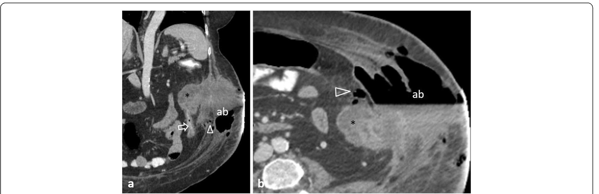 62-year-old patient with colonic rupture into the abdominal