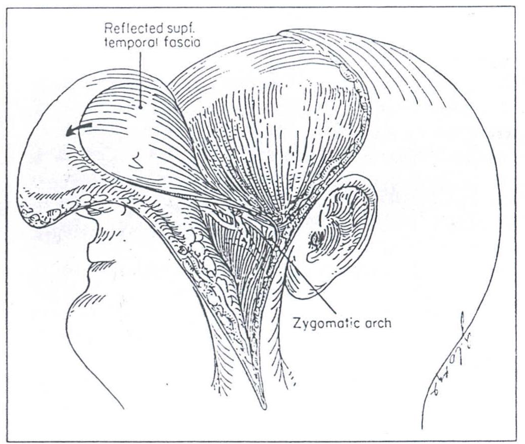 (PDF) An Anatomicosurgical Study of the Temporal Branch of the Facial Nerve