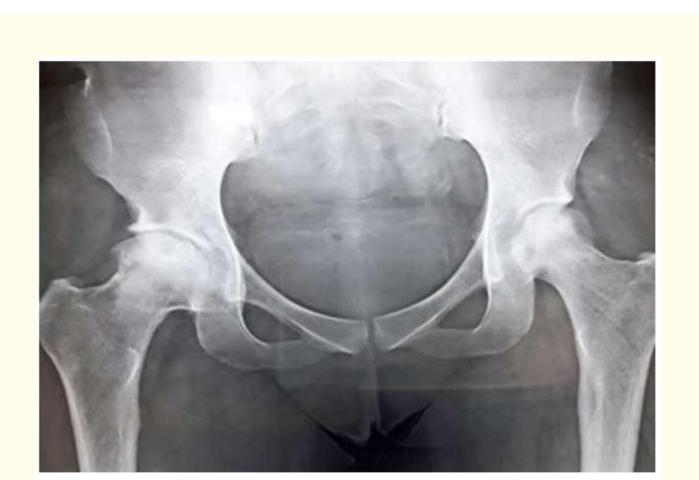 (PDF) Bilateral Osteonecrosis of Femoral Head in Sickle Cell Disease ...