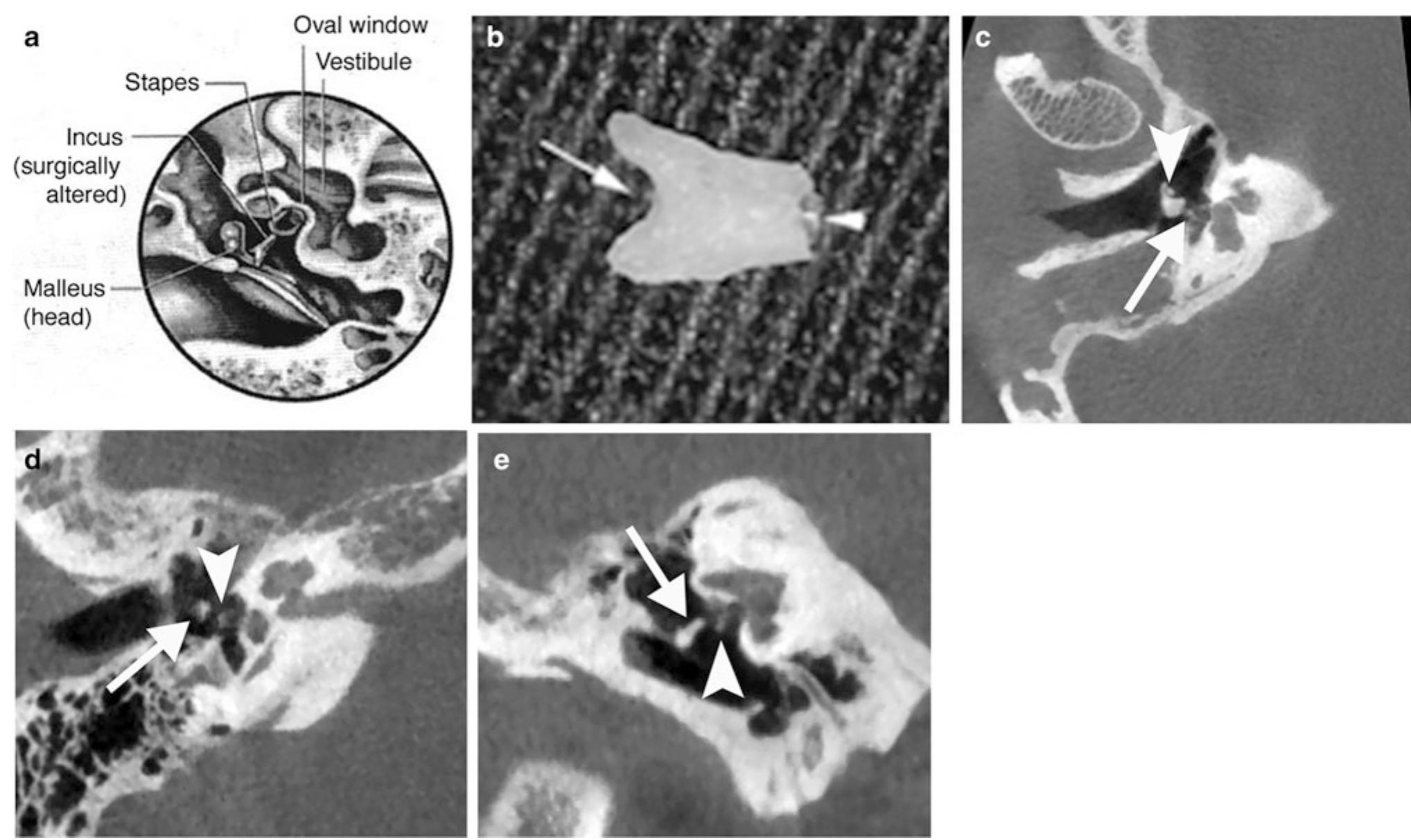 Invus Bone Incus interposition a diagram shows a surgically altered
