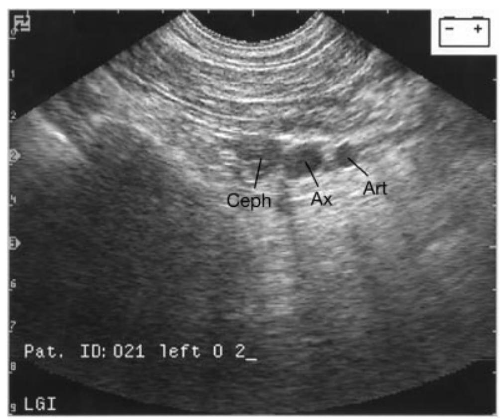 Figure 6 - Ultrasound imaging of the axillary