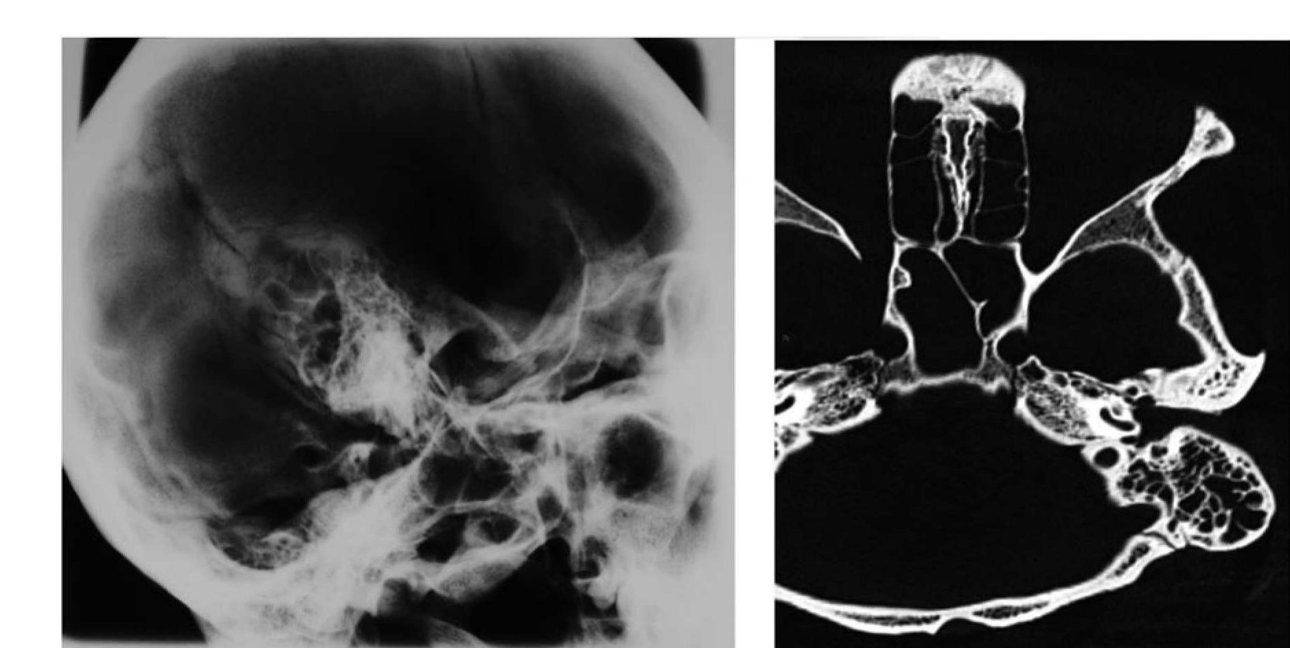 (PDF) External ear canal exostosis and otitis media in temporal bones ...