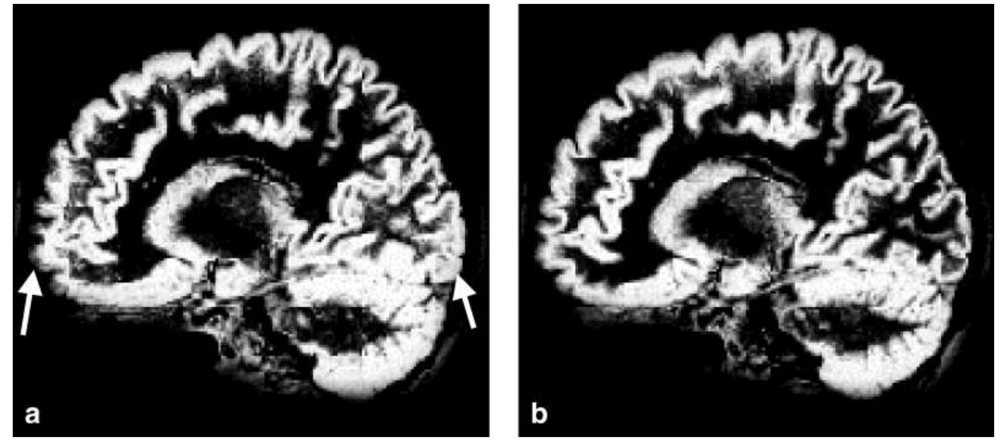 Sagittal cross sections of gm maps acquired with (a) 1d and