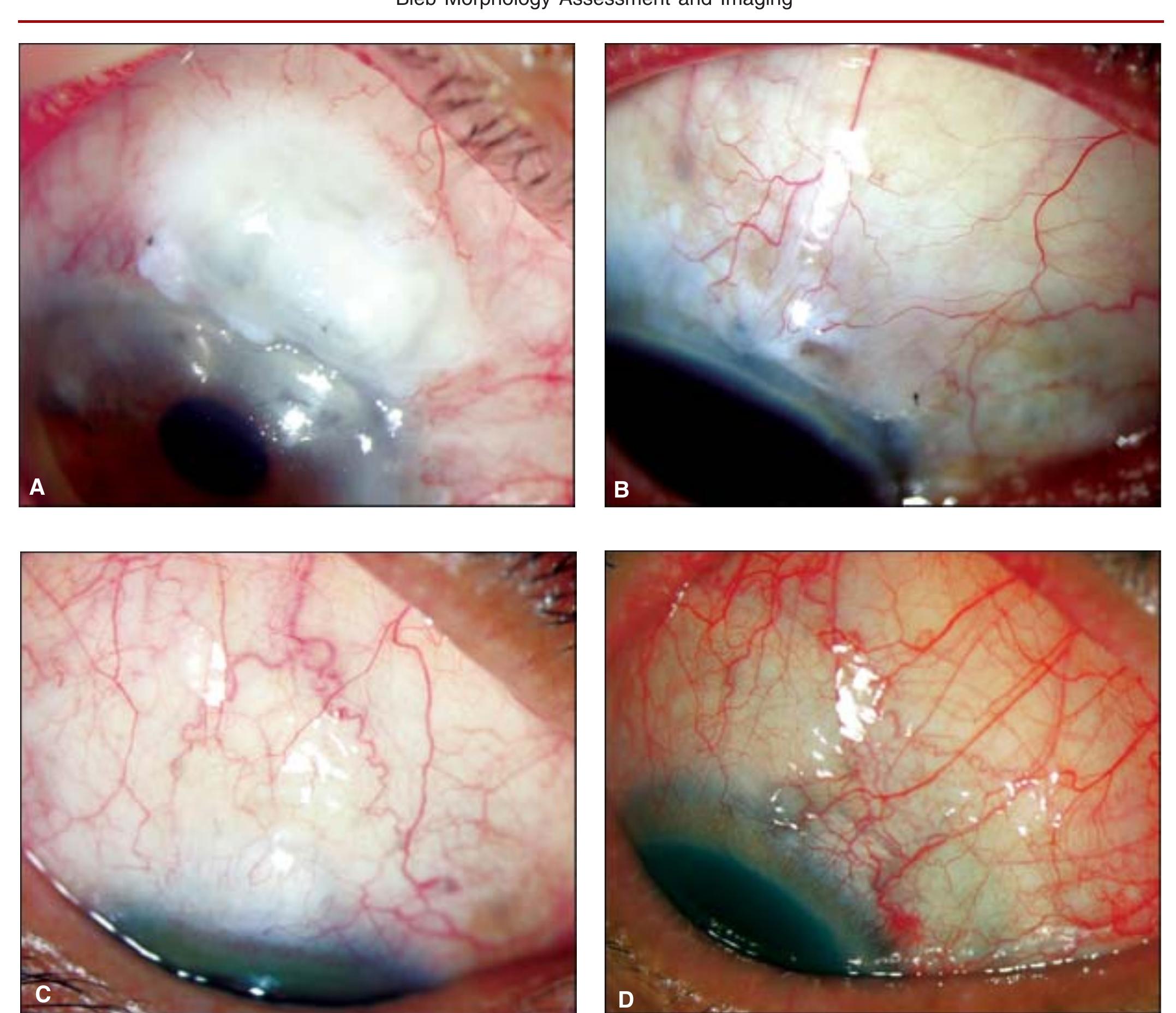 Bleb Structure (PDF) Bleb Morphology Assessment and Imaging