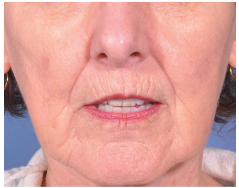 Forehead Rhytids (PDF) The Rejuvenation of the Aged Central Lower Face: A Contemporary ...