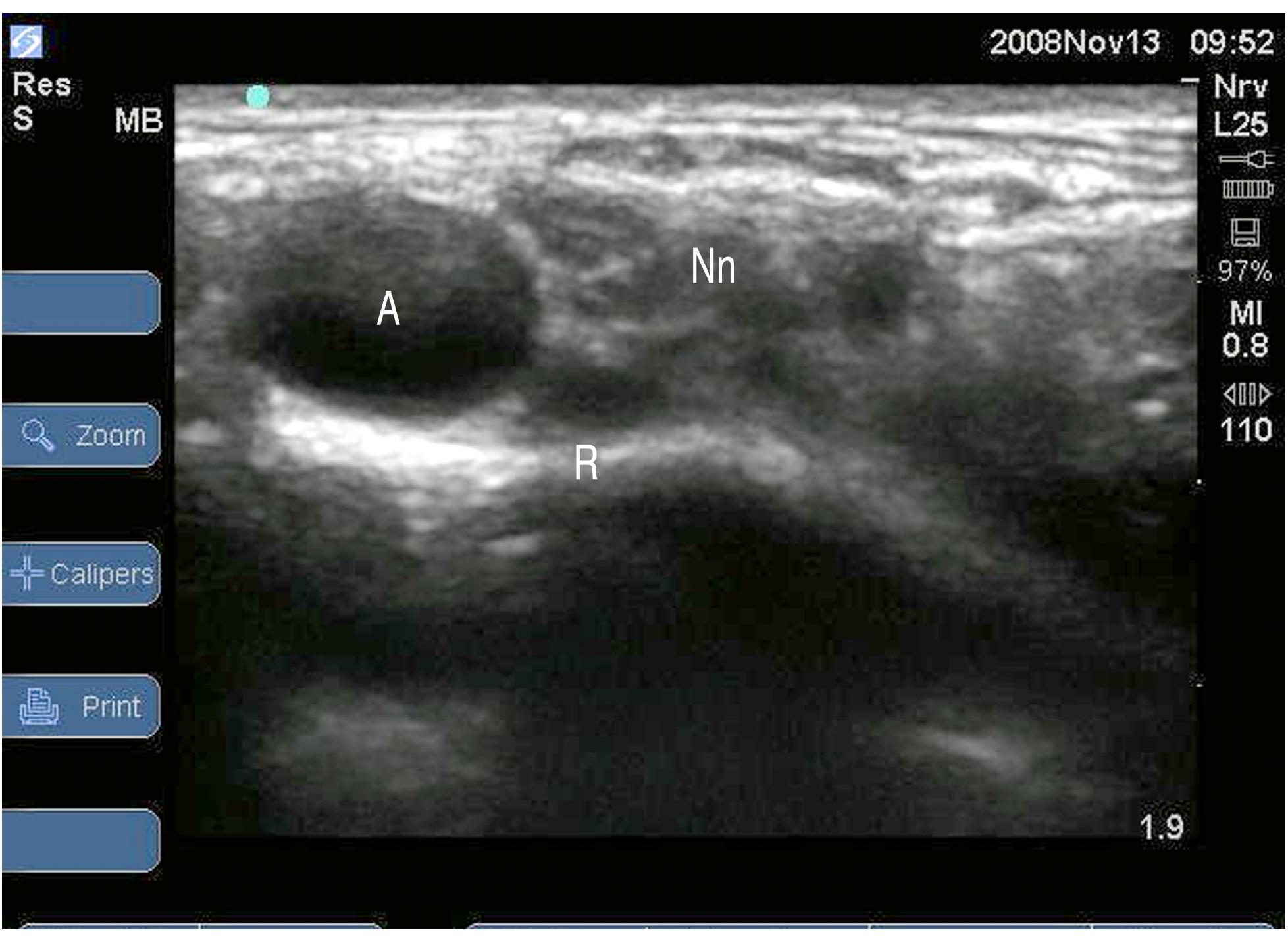 Ultrasound scan of supraclavicular region, revealing the