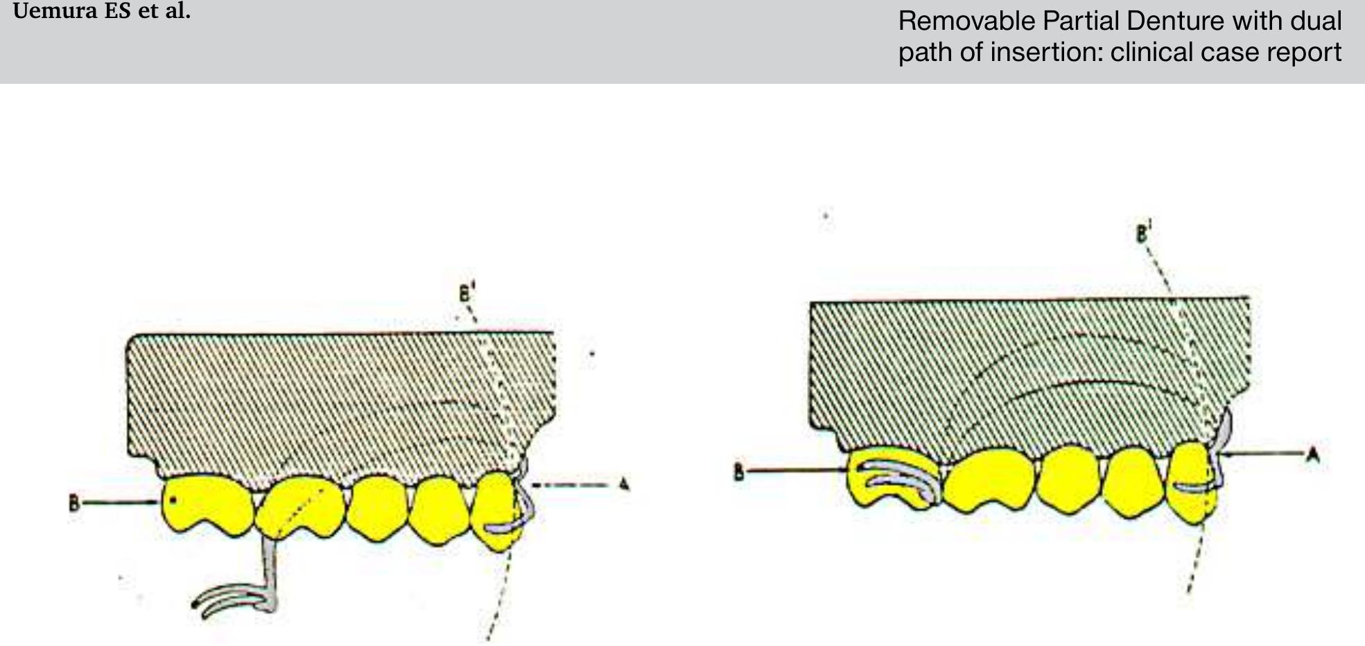 (PDF) Removable Partial Denture with dual path of insertion: clinical ...