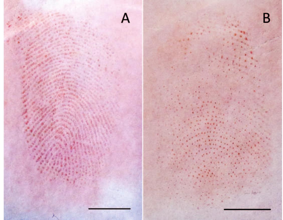 (PDF) Immunolabeling of fingermarks left on forensic relevant surfaces ...
