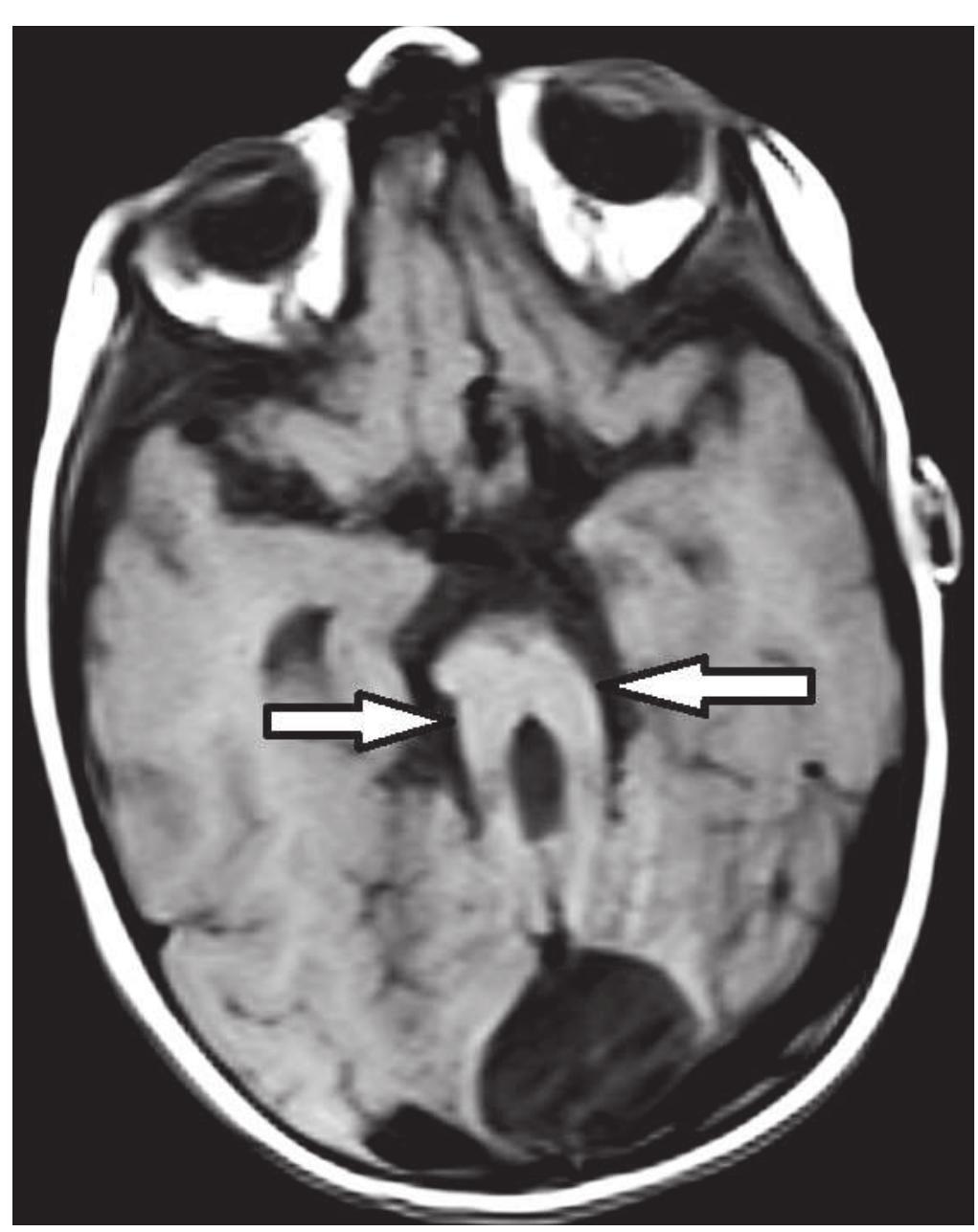 Molar tooth sign. transverse t1wi of mri demonstrates