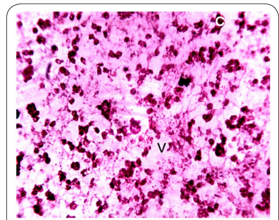 Plate 3. Photomicrograph of Kidney of Clarias gariepinus obtained from Station 1 after 14 days bio-assay in  River Galma at x400. The letters V and C indicate  severe vacoulation of the tissue and, constriction and aggregation of cells respectively.  Samuel et al. Applied Scientific Reports 2017, http://www. hoajonline.com/journals/pdf/2054-9903-4-1.pdf 