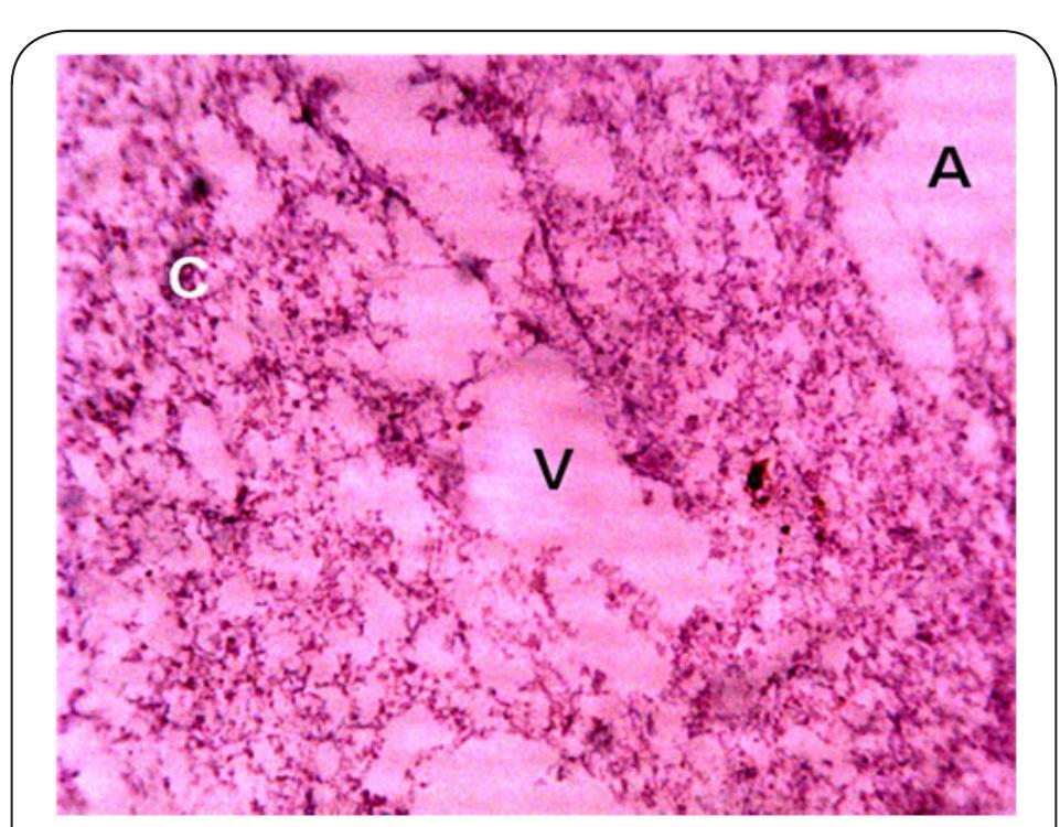 Plate 5. Photomicrograph of Kidney of Clarias gariepinus obtained from Station 2 after 14 days bio-assay in River Galma at x 400. The letter V indicates severe vacoulation of the tissue. The letter C indicates constriction, hypertrophy and aggregation of cells. (A) stands for necrosis and infilteration of the cells. 