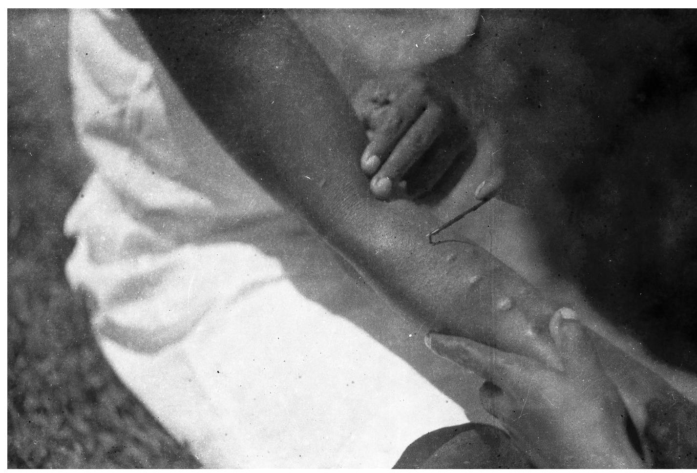 The process of scarification by pinching the skin and