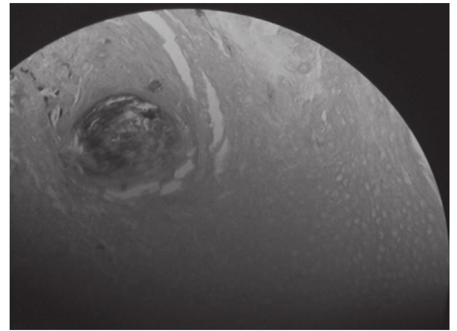Shadow Cell (PDF) Pilomatricoma-Study of 3 cases and review of literature