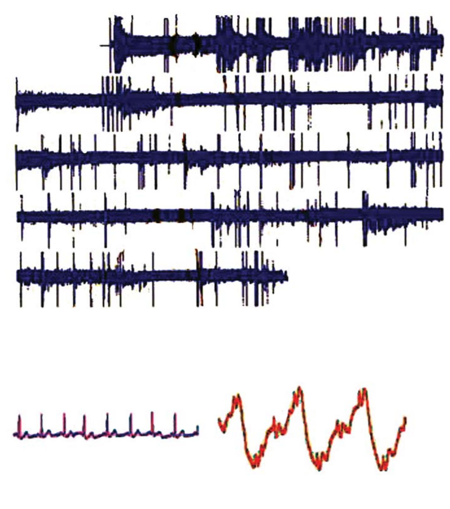 (6). a typical example of the bed ecg monitor. the bed ecg