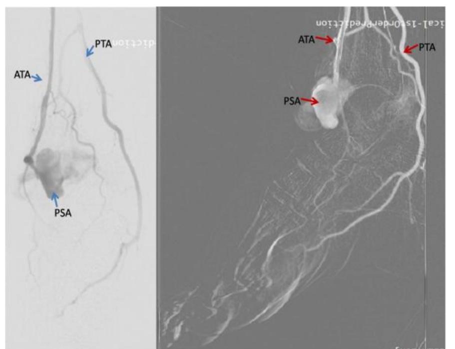 (PDF) Successful Endovascular Management of Large Traumatic Anterior ...