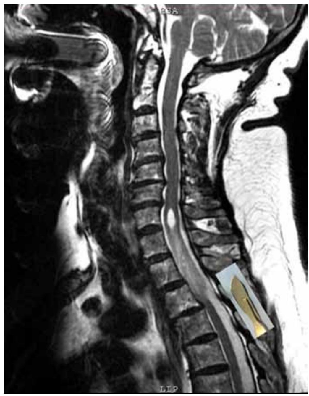 Sagittal t2-weighted mri imaging of the thoracic spine at