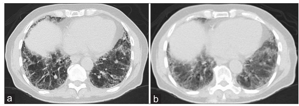 (PDF) Approach to acute exacerbation of idiopathic pulmonary fibrosis