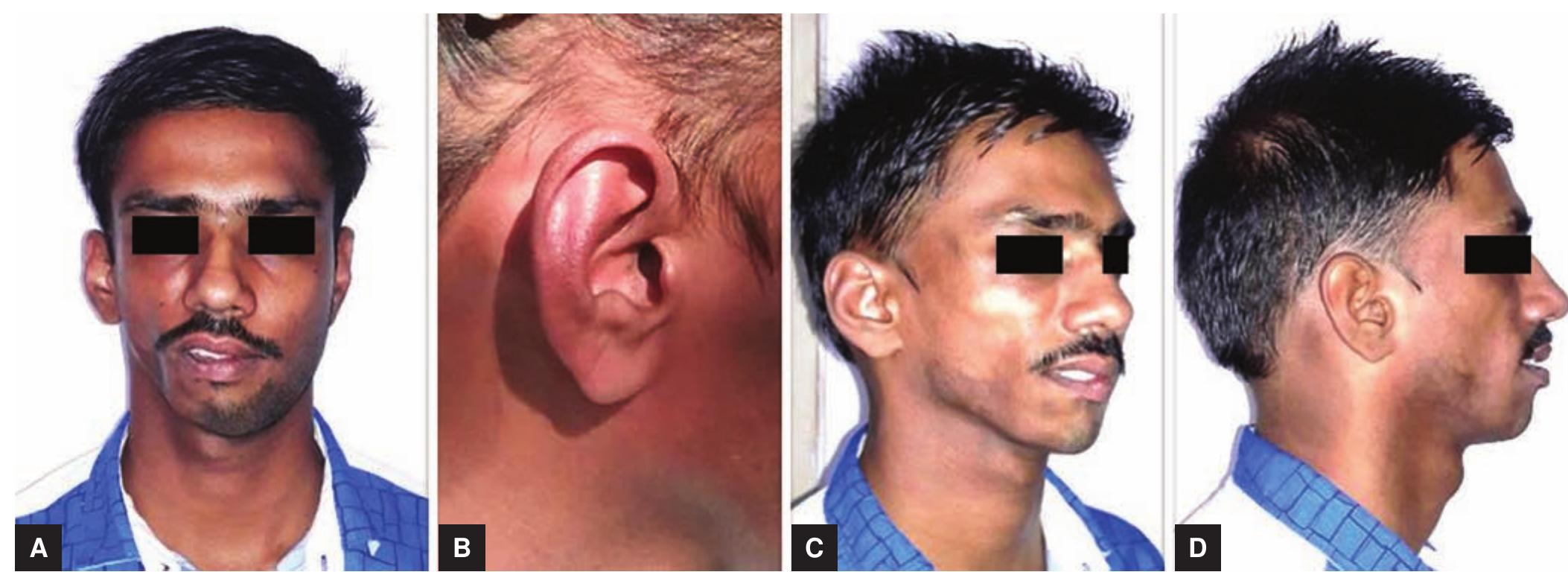 Figure 1 - from Parry–Romberg Syndrome: An Orthodontic